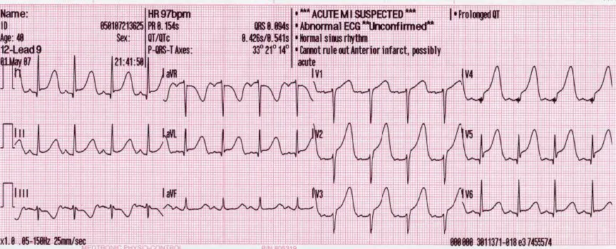 12 lead generated anterior MI