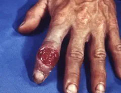 Syphilis