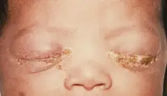 A baby who contracted Gonorrhea from its mother
