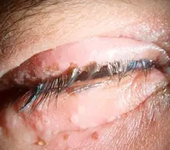 Herpes simplex
