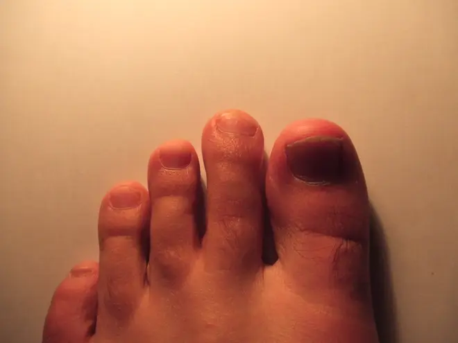 Mortons toe